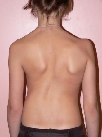 Scoliosis 2 chéim