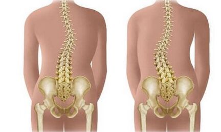 Scoliosis neamh -resistant