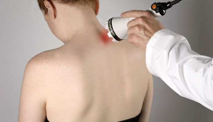 teiripe léasair le haghaidh osteochondrosis ceirbheacsach