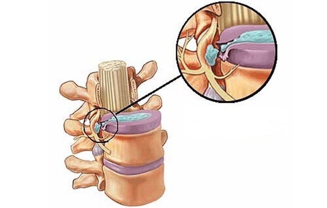 hernia intervertebral le osteochondrosis thoracach