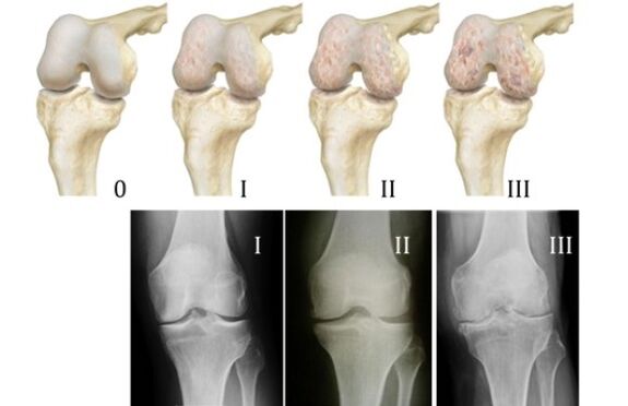Modhanna chun arthrosis glúine a dhiagnóiseadh