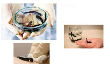 hirudotherapy le haghaidh airtríteas